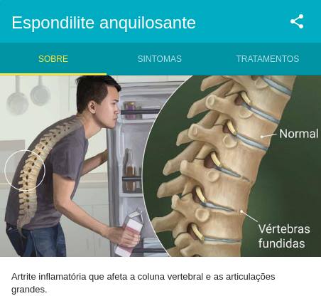 Doenças Graves para Isenção do Imposto de Renda 2 Espondilite - Doença Grave - Isenção do Imposto de Renda